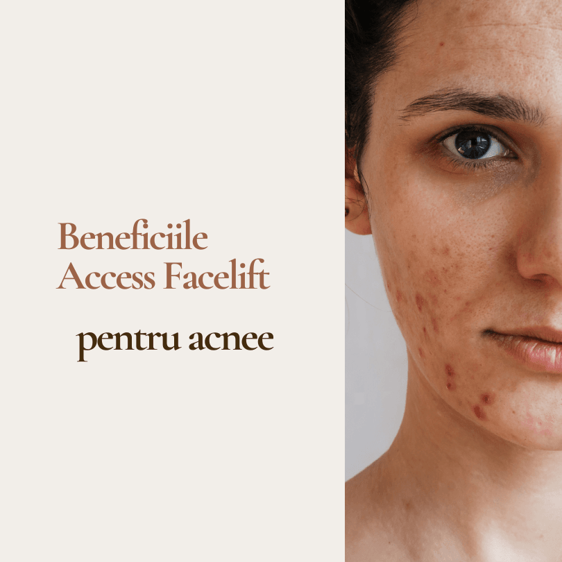 access facelift pentru acnee
